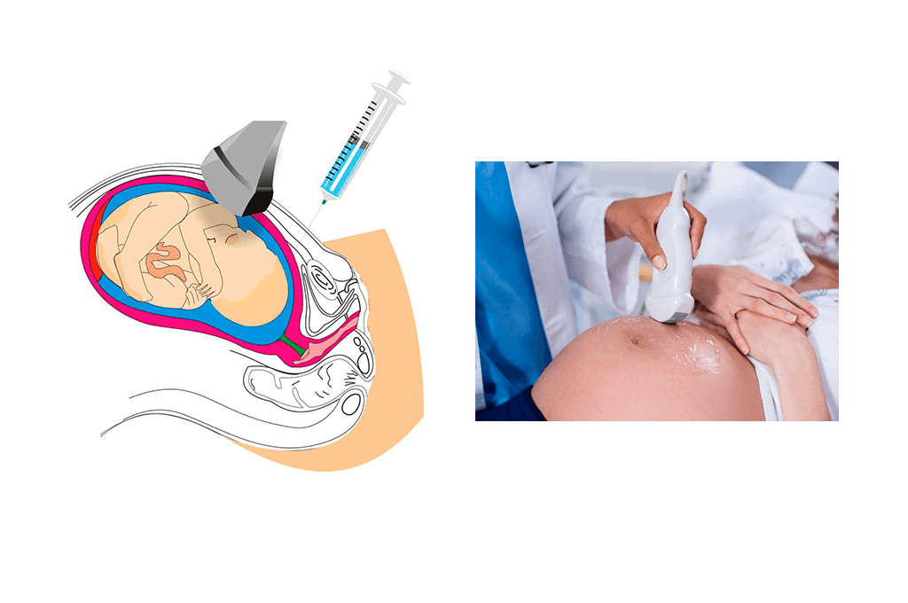 Amniocentesis Genética (Cariotipo Fetal)